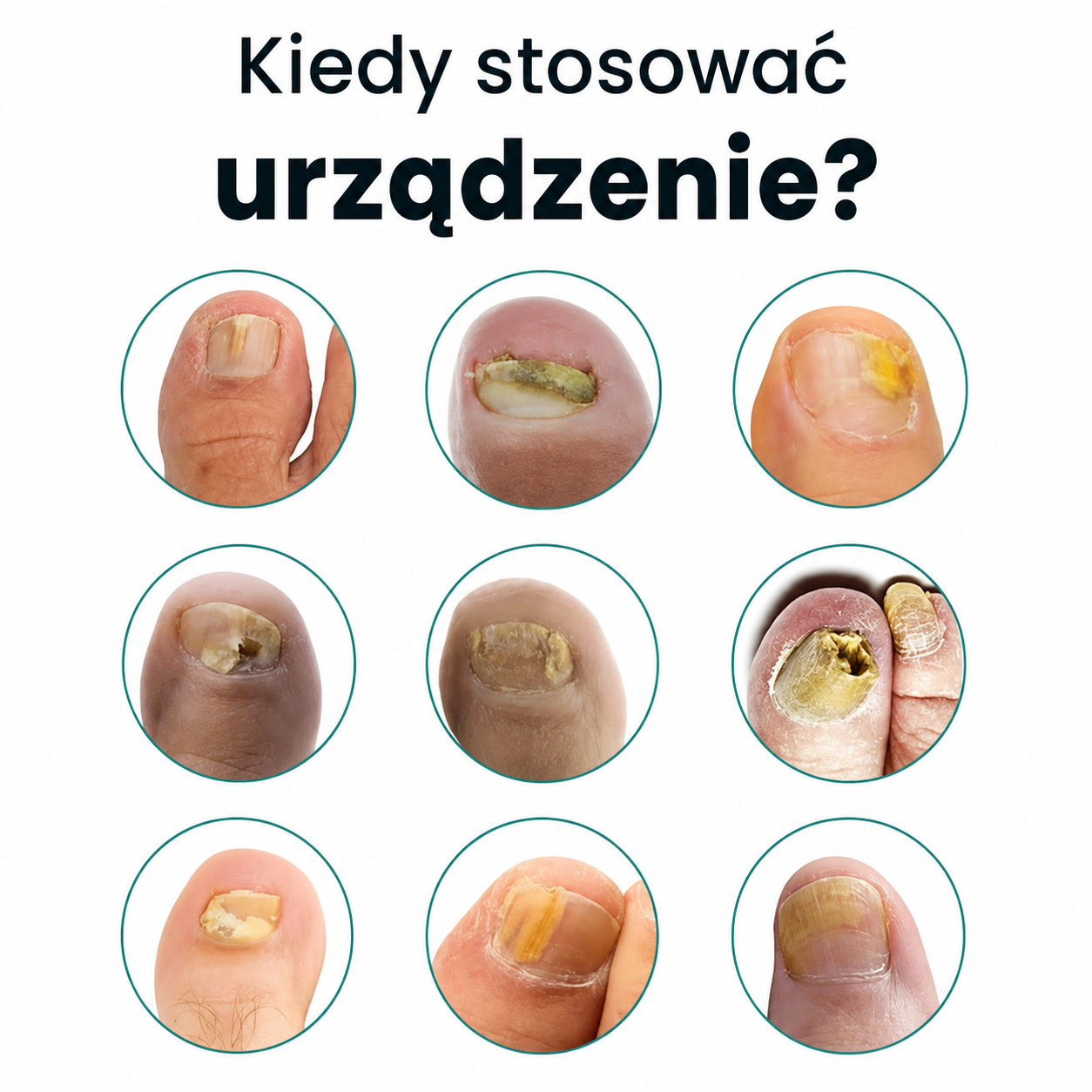 DermalPulse™ – Skuteczne leczenie grzybicy paznokci