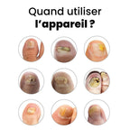 DermalPulse™ – Skuteczne leczenie grzybicy paznokci