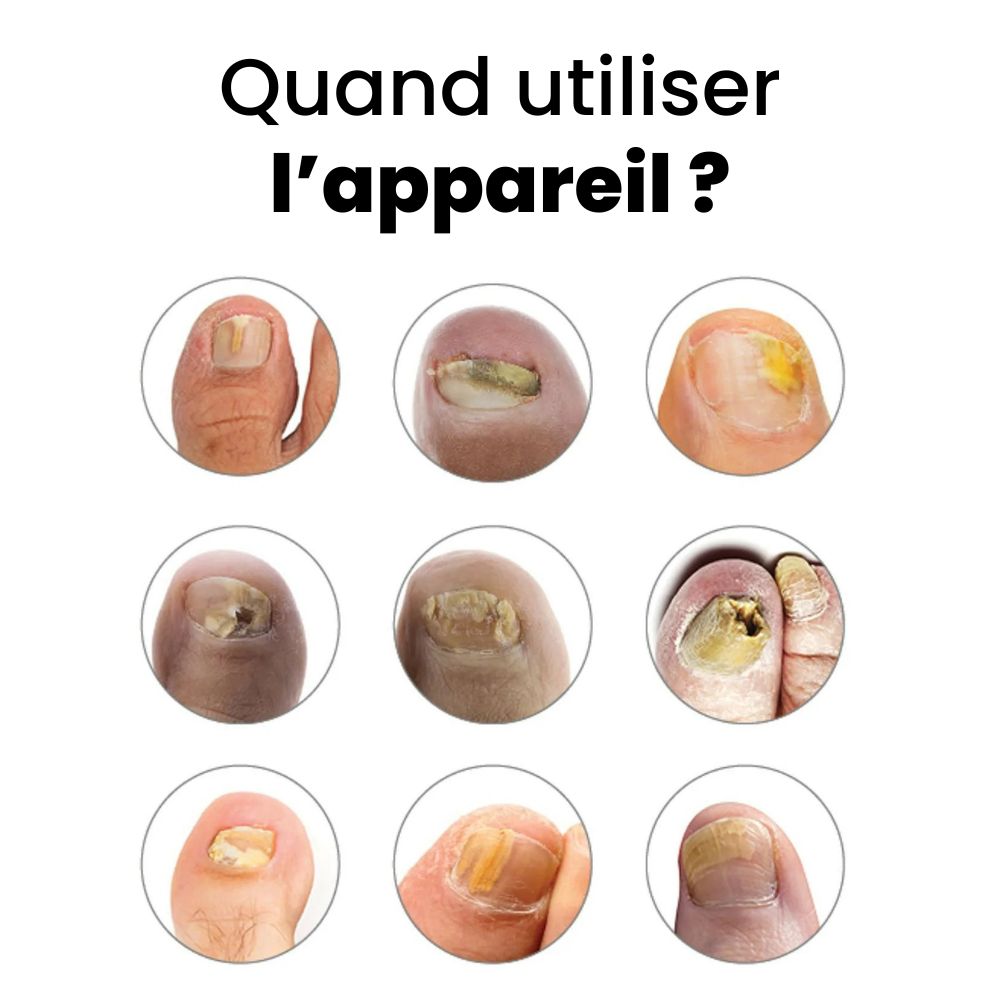 DermalPulse™ – Skuteczne leczenie grzybicy paznokci