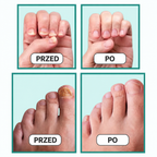 DermalPulse™ – Skuteczne leczenie grzybicy paznokci