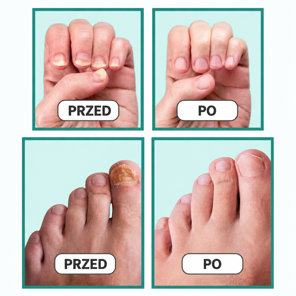 DermalPulse™ – Skuteczne leczenie grzybicy paznokci